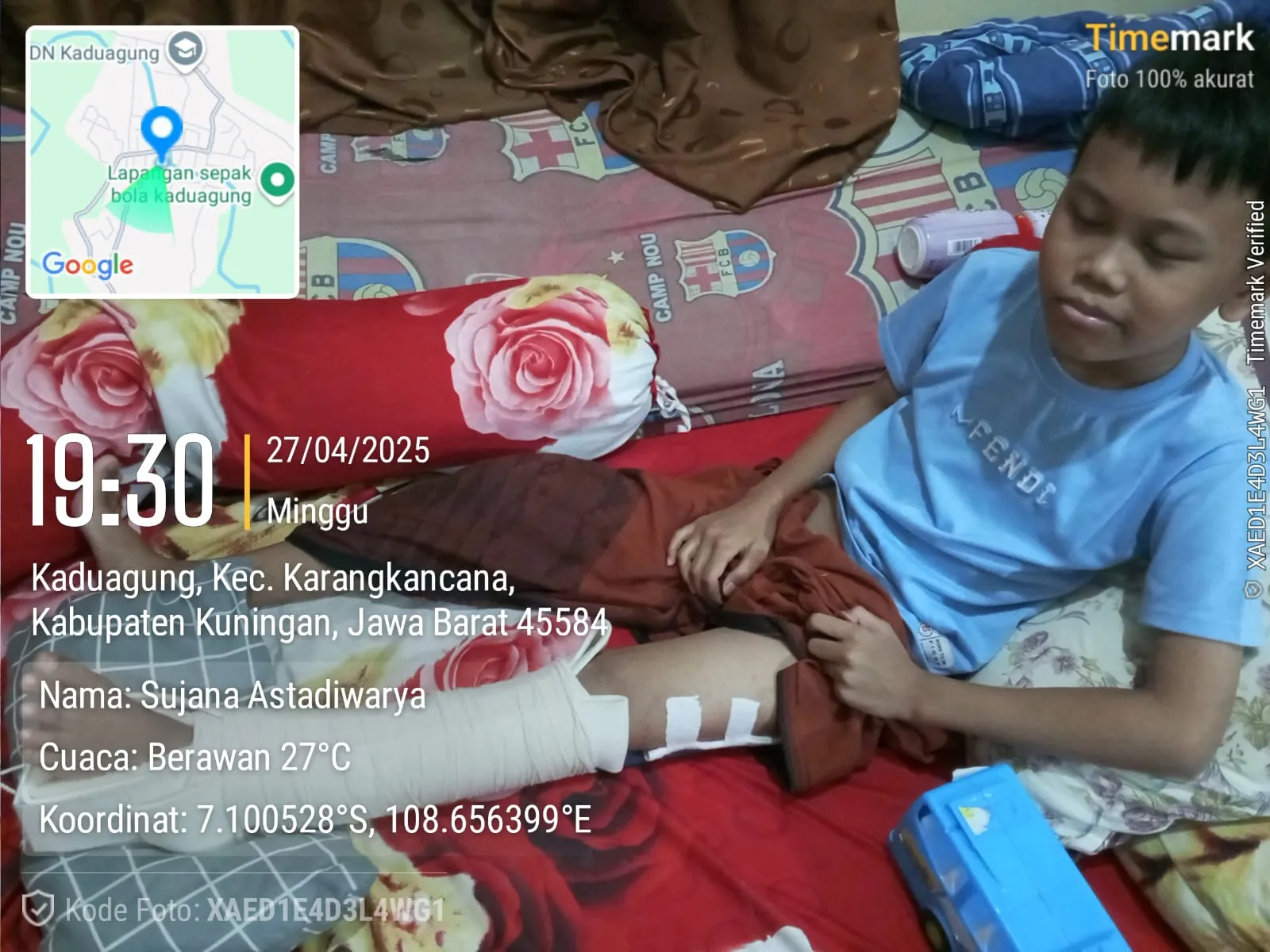 Derita Arief Ripai, Bocah 12 Tahun dari Kaduagung, Karangkancana, yang Berjuang Melawan TB Tulang